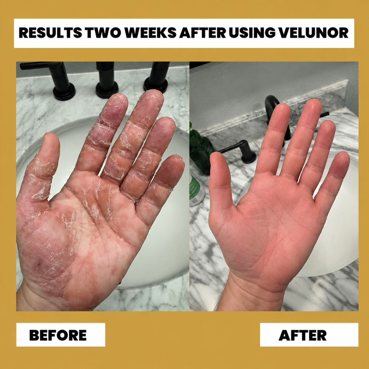 Finally Get Real Relief From Dyshidrotic Eczema With Velunor