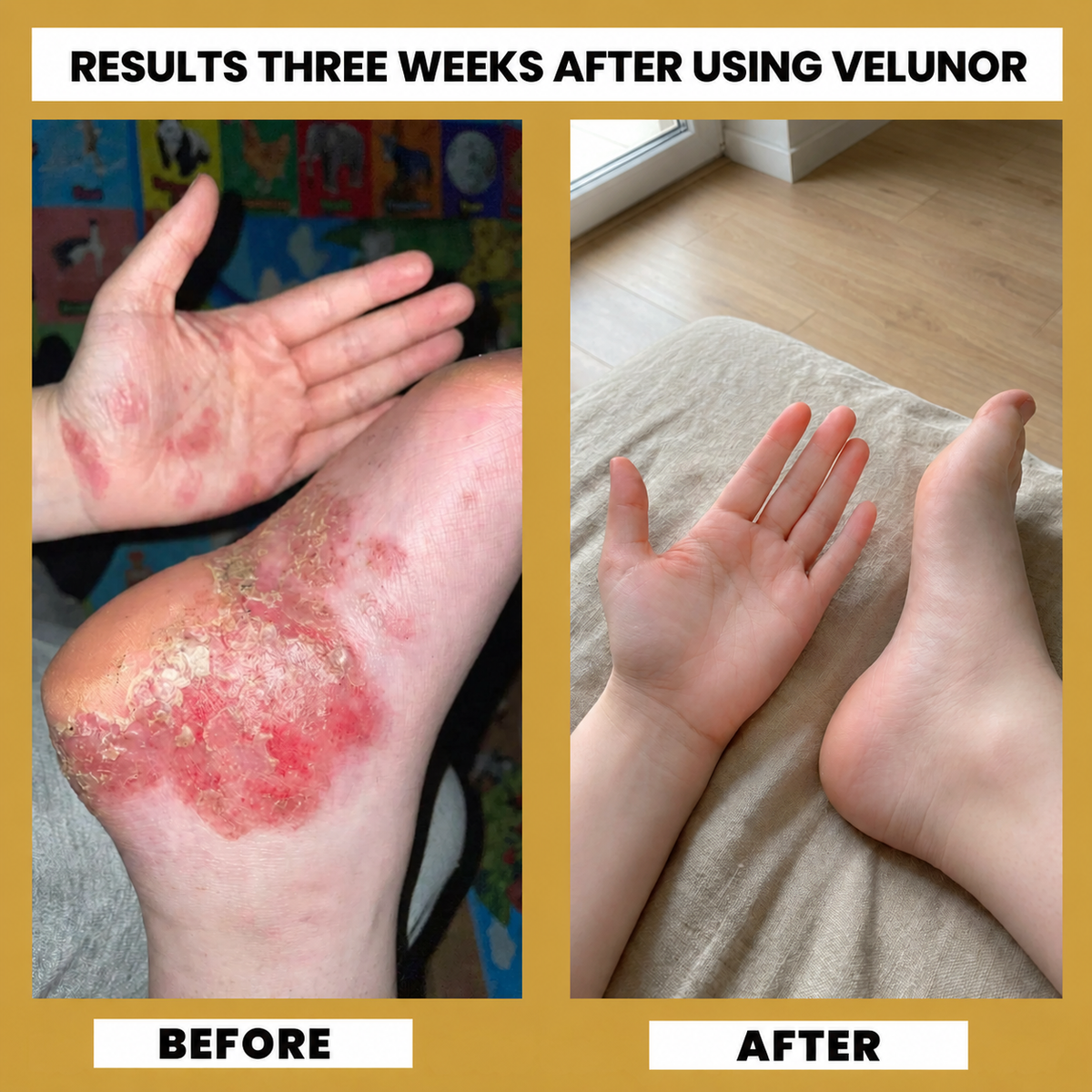 Finally Get Real Relief From Dyshidrotic Eczema With Velunor