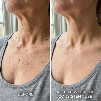 MOIKA — Advanced Keratolytic Cream For Rough, Raised Seborrheic Keratoses-K$