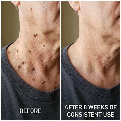 MOIKA — Advanced Keratolytic Cream For Rough, Raised Seborrheic Keratoses-K$