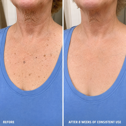 MOIKA — Advanced Keratolytic Cream For Rough, Raised Seborrheic Keratoses-K$