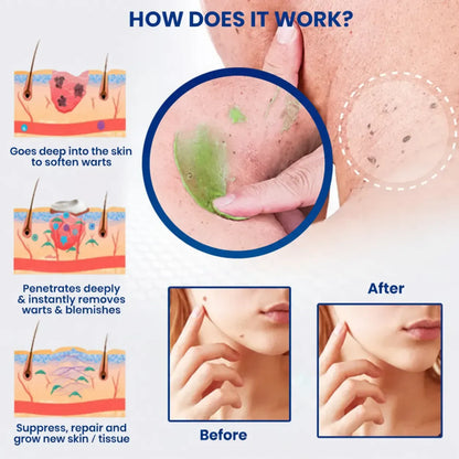Hoygi SKIN ERASE：Erase Unwanted Marks in 7 Days Without Surgery, Pain, or $650 Doctor Bills