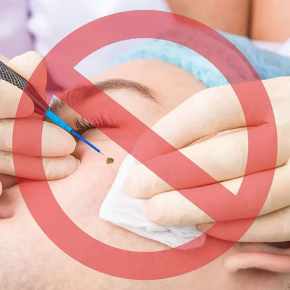 Hoygi SKIN ERASE：Erase Unwanted Marks in 7 Days Without Surgery, Pain, or $650 Doctor Bills
